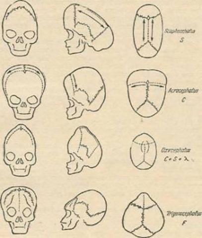 Как выглядит голова новорожденного ребенка Микроцефалия - стр. 198 - ДЦП. Всё, что мы знаем об этом заболевании - Форум соо